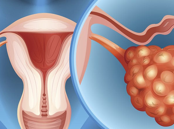 Cáncer de Ovario: Mortalidad y Detección Precoz